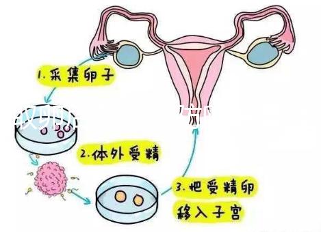 取卵后怎么預防卵巢囊腫？5種科學方法值得學習