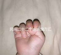 民間二十二個退燒偏方匯總，生雞蛋清、生姜放腳底還有…