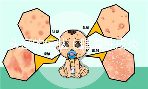 頭癬的癥狀(脂溢性皮炎和頭癬區別)