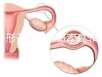 弓形子宮流產(chǎn)概率高非個例！罪魁禍?zhǔn)资沁@個原因