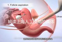 解讀上海人工授精的具體過程，會(huì)不會(huì)痛看醫(yī)生怎么說？