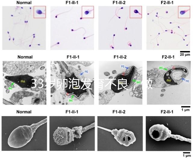 33歲卵泡發育不良，做試管黃體期促排方案失敗怎么辦？